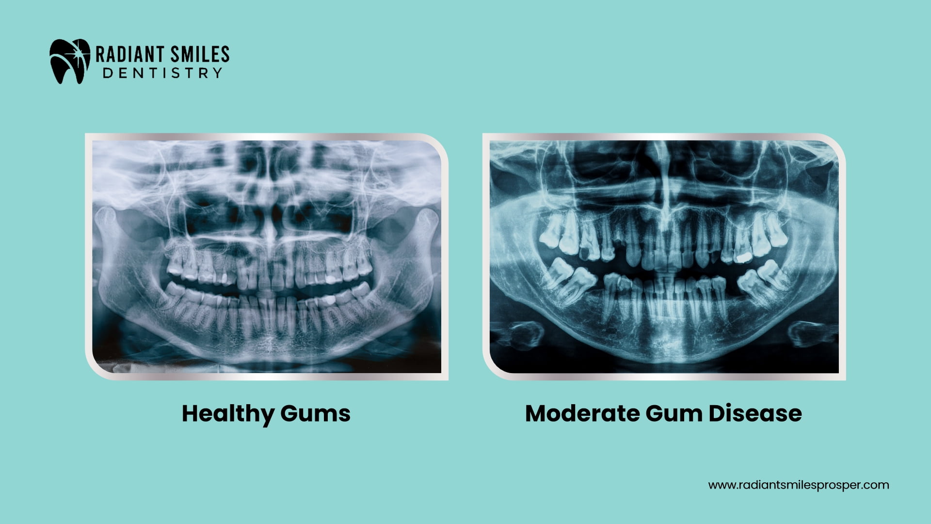 How is Gum Disease Identified?