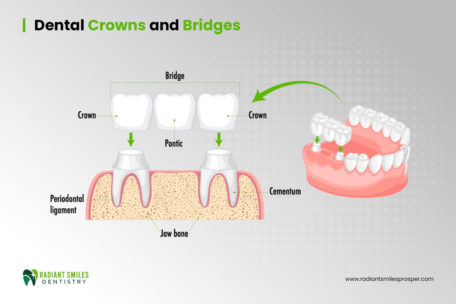 Exploring the advancements in Dental Crowns And Bridges