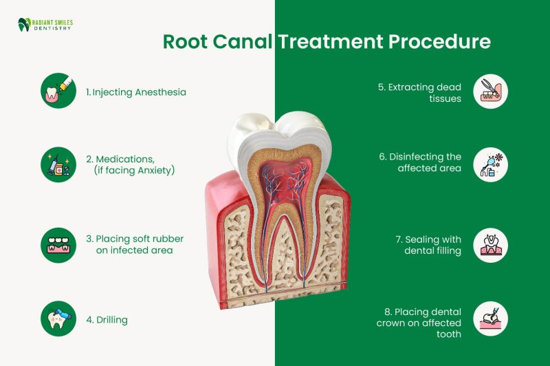 step-by-step root canal treatment process