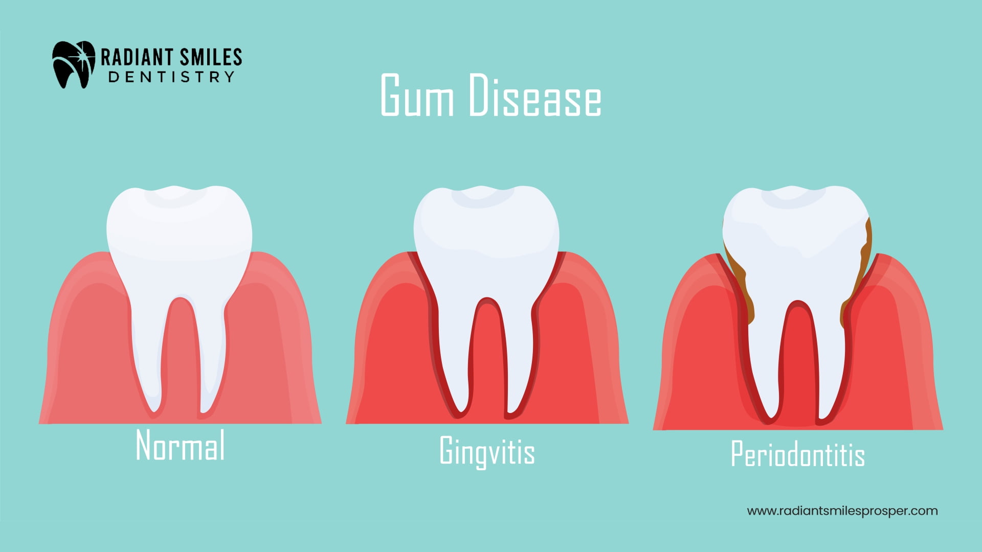 What is Gum Disease?