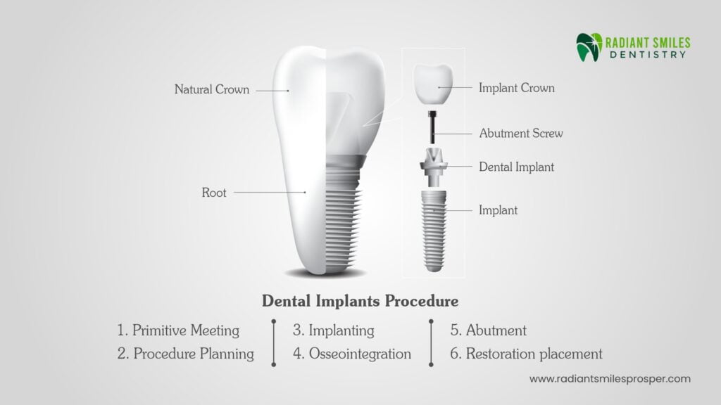 Dental Implants Procedure