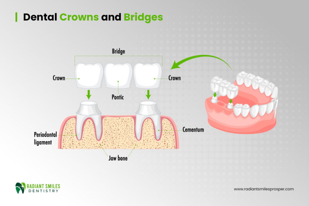 Dental Crowns and Bridges