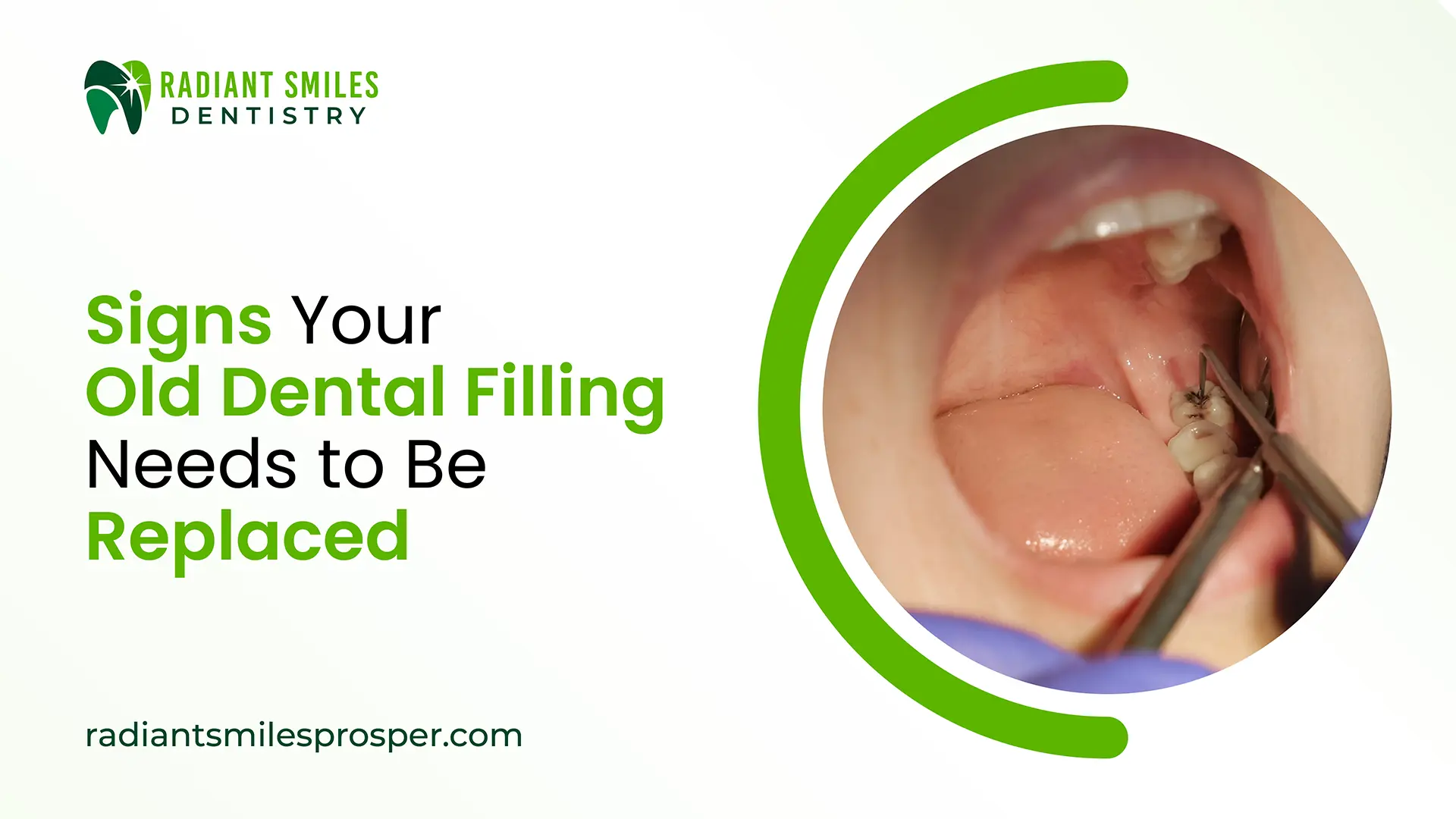 Dental filling replacement