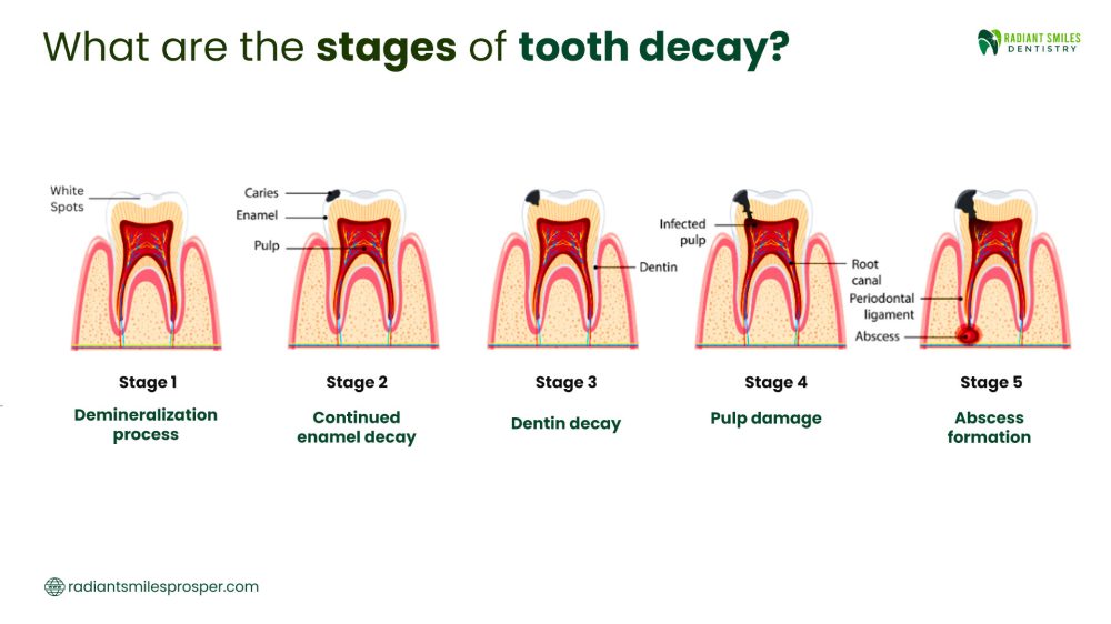 What are the stages of tooth decay?