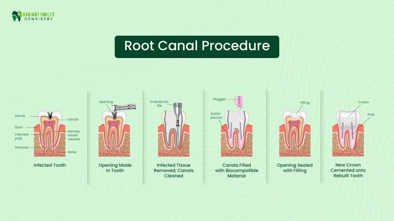 root canal procedure root canal procedure